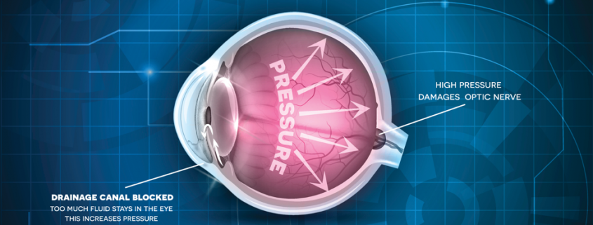 glaucoma-eye-diagram